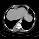 Paravertebral lymphoma: CT - Computed tomography